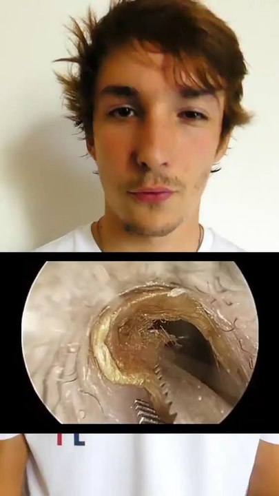 Bouchon de cérumen 🤯