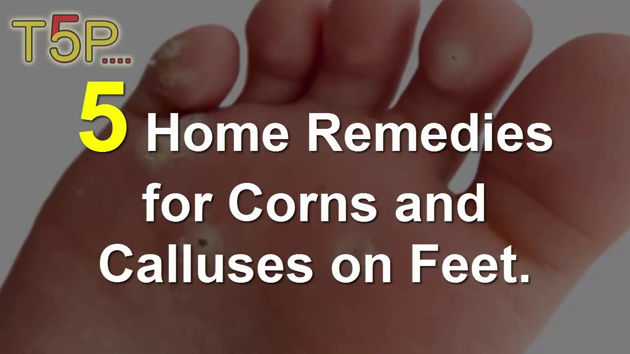 5 Home Remedies for Corns on Feet
