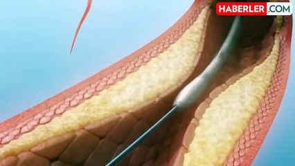 Mide balonu ameliyatı yasaklandı mı 2025?