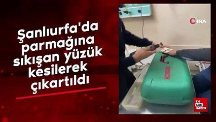 Şanlıurfa'da parmağına sıkışan yüzük kesilerek çıkartıldı