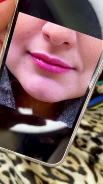 Transform Your Look with Expert Lip Filler Injections | Novin Ariana Clinic 💋✨