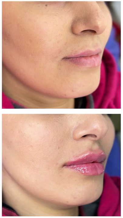 "Your Trusted Destination for Dermal Fillers | Novin Ariana Clinic 💋"