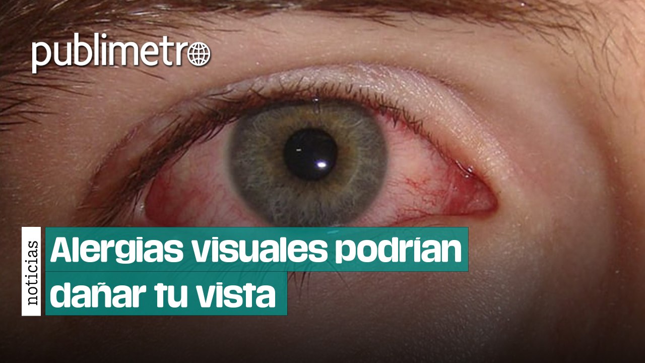 Alergias visuales en invierno podrían dañar tu vista: causas, síntomas y recomendaciones médicas