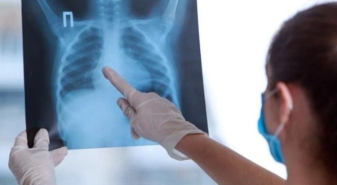 'Verem hastalığının teşhisi kolay, tedavisi de var'