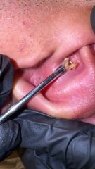 Black head removal from ear satisfying ASMR