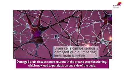 Stroke | Exercises & Techniques for facial paralysis