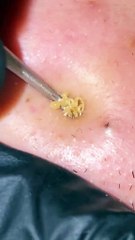 Skin care removal of black head from chicks satisfying ASMR