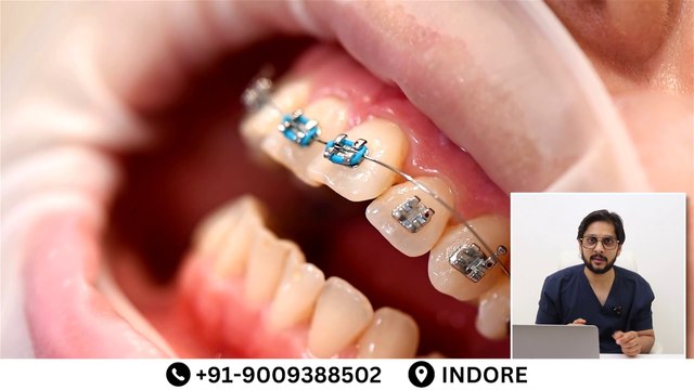 ब्रैसेज के प्रकार और उनकी कीमत | Types of Teeth Braces and Their Cost in indore