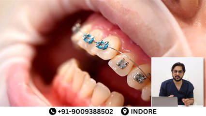 ब्रैसेज के प्रकार और उनकी कीमत | Types of Teeth Braces and Their Cost in indore