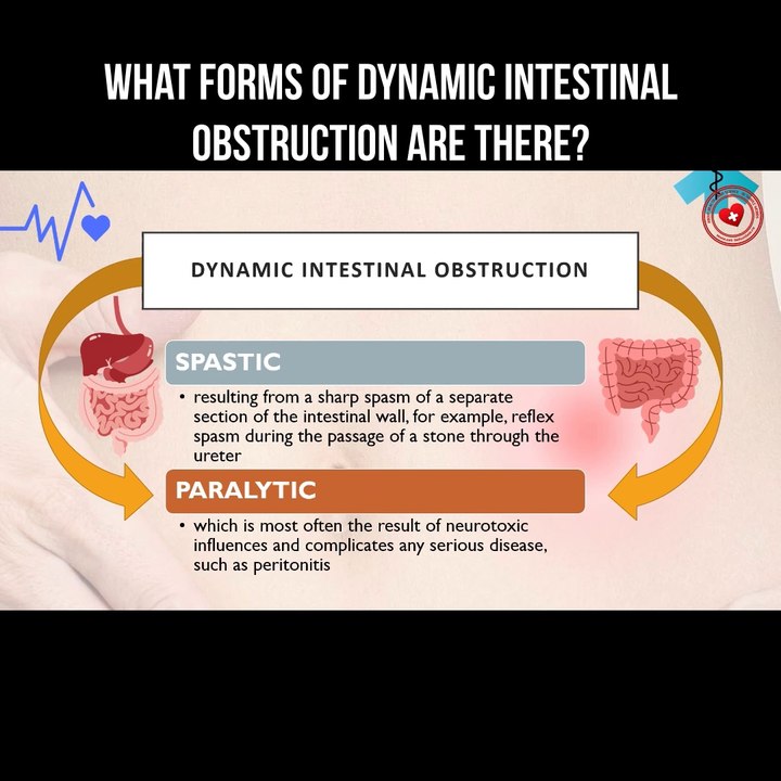 What forms of dynamic intestinal obstruction are there?
