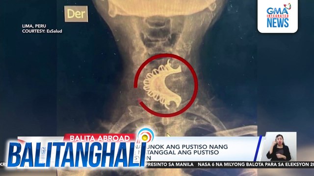 Lalaking 81-anyos, nalunok ang pustiso nang atakihin ng epilepsy; natanggal ang pustiso matapos ang operasyon | Balitanghali
