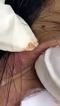 Big Cystic Acne Blackheads Extraction Blackheads & Milia, Whiteheads Removal Pimple Popping