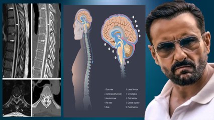 Saif की रीढ़ में चाकू फंसने से हुआ Spinal Fluid Leakage, की गयी Emergency Surgery!