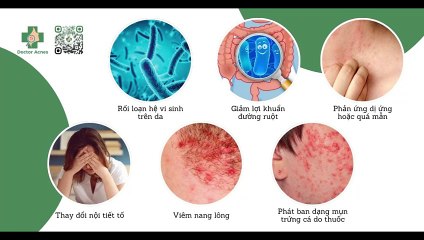 Uống kháng sinh bị nổi mụn: nguyên nhân và cách khắc phục