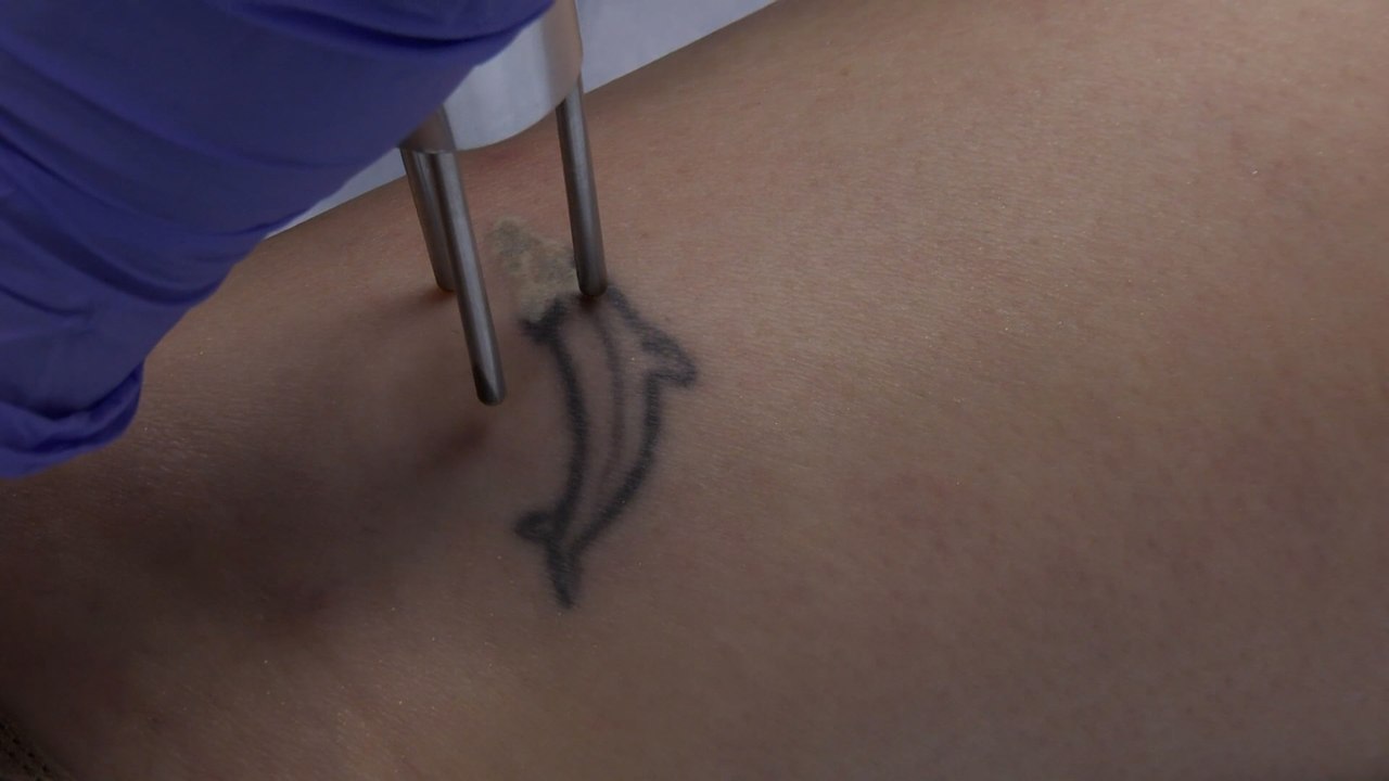 Su Salud - ¿Es posible borrar un tatuaje por completo?