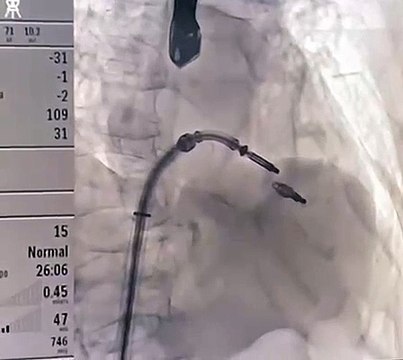 Primer caso de reparación de válvula mitral en Mendoza, pionera en la región de Cuyo