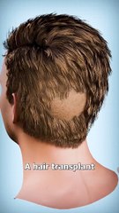 How Hair Transplants Work 🤨 #physics #science