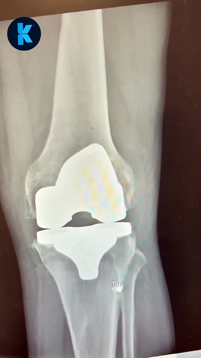 A Success Story Six Weeks After Robotic Knee Replacement 🌟