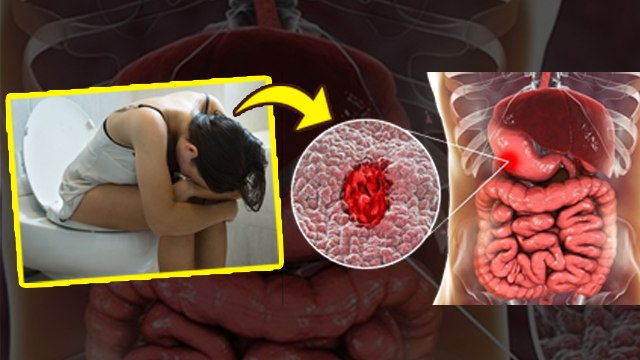 Intestinal Inflammation Symptoms In Hindi: आंत में सूजन के लक्षण, सुबह दिखते ही जांच कराएं |Boldsky