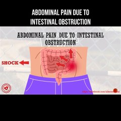 Abdominal pain due to intestinal obstruction