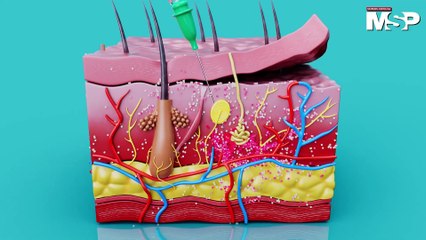 Innovación subcutánea en tratamientos de cáncer