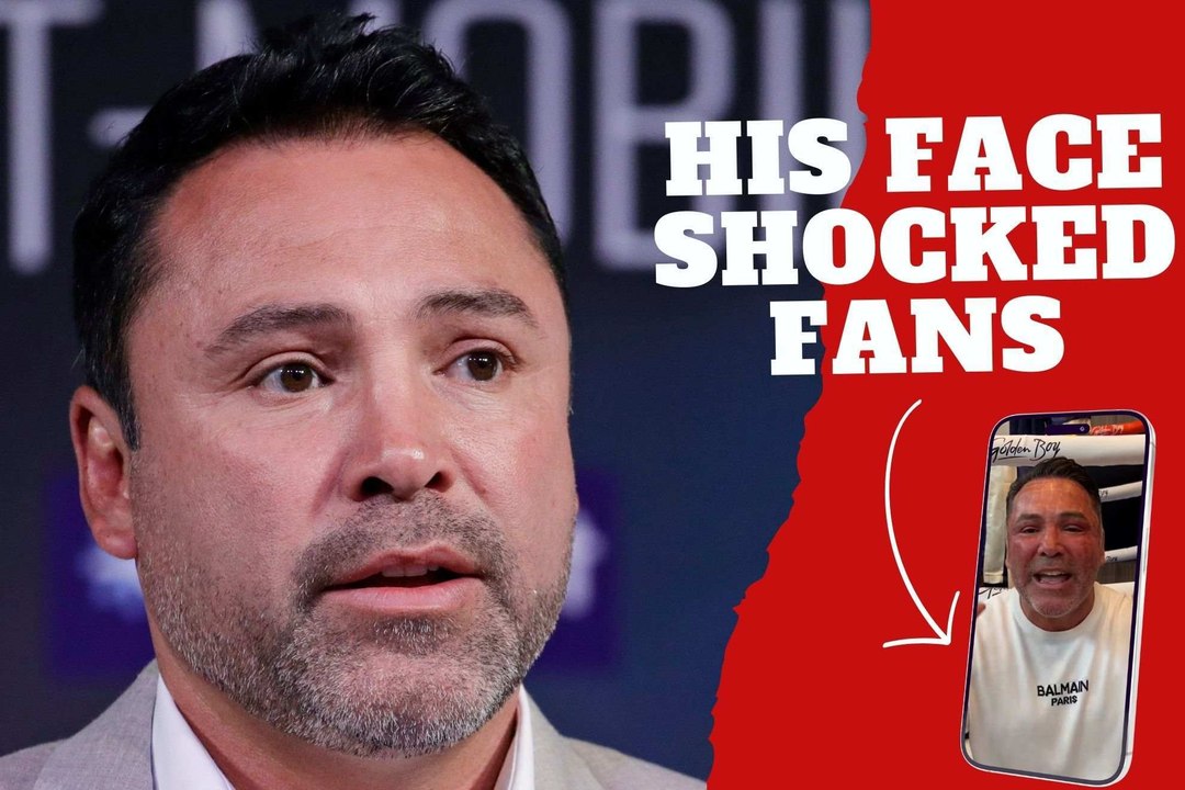 Fans were shocked! Oscar De la Hoya shows his very damaged face after a laser skin intervention