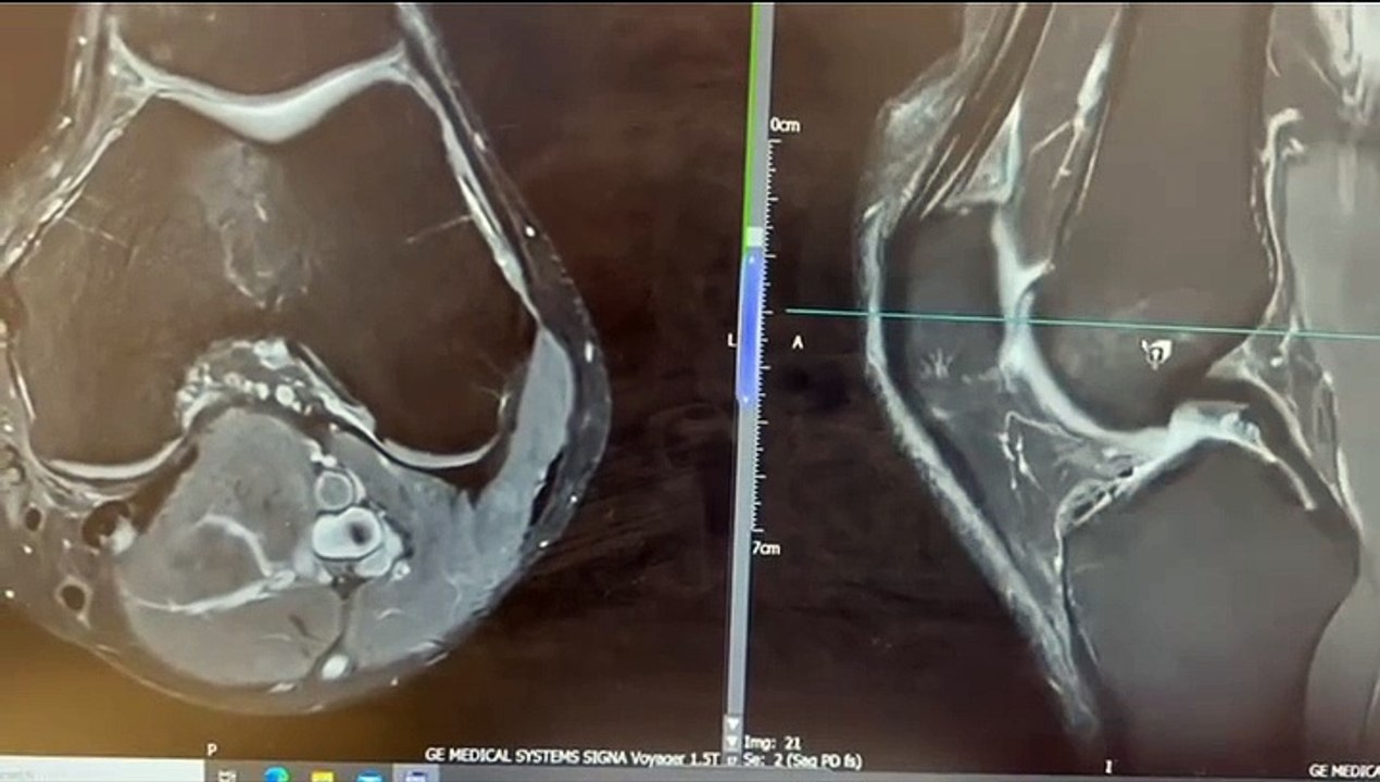 Deciphering Knee Pain in a Runner via MRI Analysis 🦵