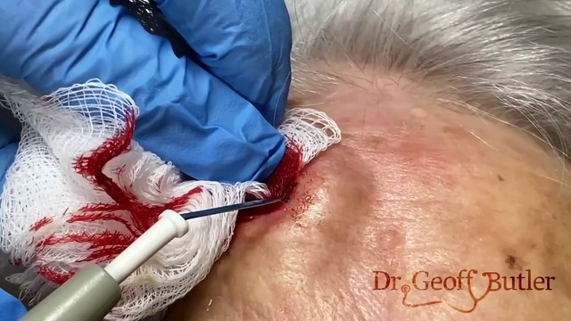 Modified Biopsy Technique for Squamous Cell Carcinoma on the Forehead: A Detailed Approach
