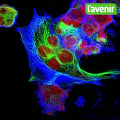 Neuroblastome cancer des enfants