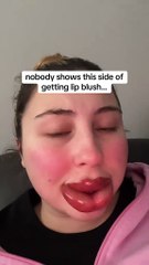 Cette femme a voulu avoir des lèvres parfaites et s’est transformée en « Boustiflor » !