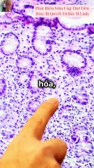 Phát Hiện Sớm Ung Thư Tiêu Hóa Bí Quyết Từ Bác Sĩ Linh