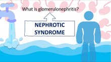 What is glomerulonephritis?