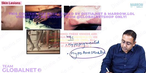 55. National Leprosy Eradication Program