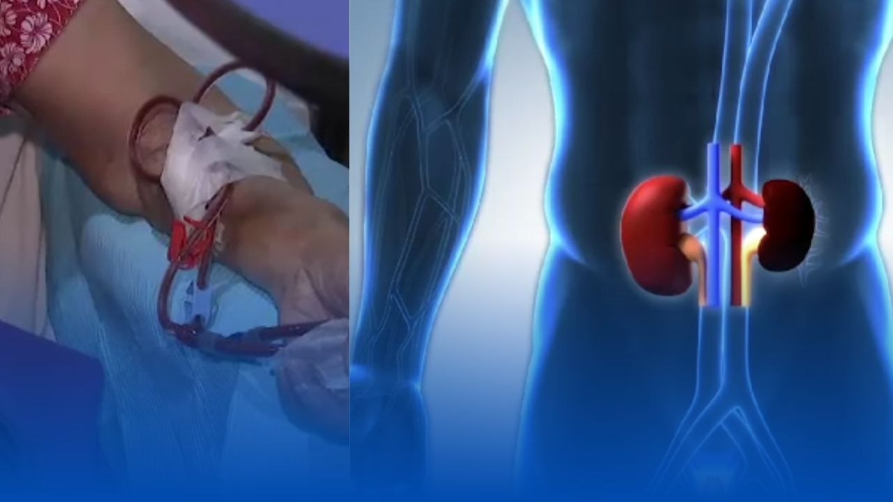 Pagkakaroon ng chronic kidney disease at acute kidney injury, pangunahing dahilan ng kidney failure