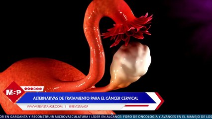 Alternativas de tratamiento para el cáncer cervical