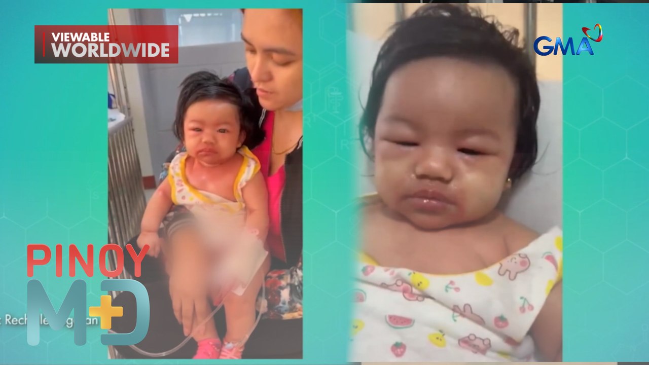 Rashes sa balat ng 5-month old baby, lumala dahil umano sa kiss?! | Pinoy MD