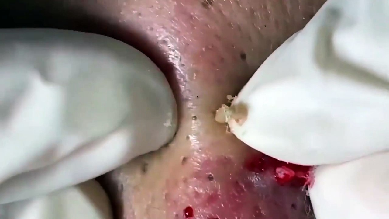 ASMR Pimple Popping: Blackhead & Whitehead Extractions (WARNING: Potentially Triggering)
