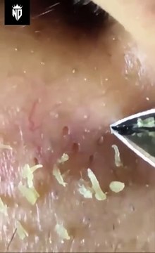 The BEST Way to Get Rid of Blackheads on Your Nose! (ASMR)