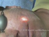 Active FX Laser Acne Scar Removal