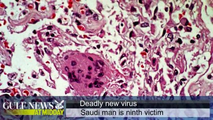 Saudi victim of SARS-like virus dies - GN Midday Wednesday Mar 13 2013