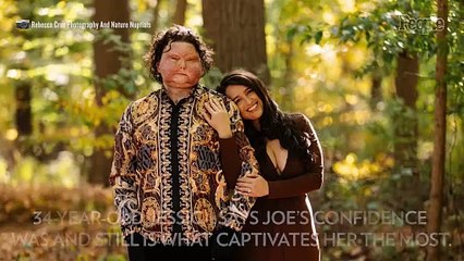 After Receiving Face of 47-Year-Old Donor During Transplant, Man 22, Falls in Love with Nurse. How It Started with 1 DM (Exclusive)