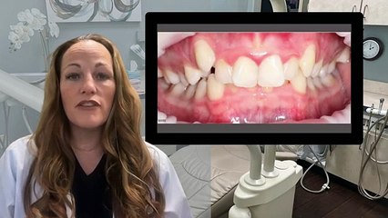 Straight Talk on Braces： Smile Correction Before and After