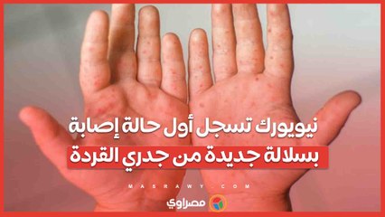 نيويورك تسجل أول حالة إصابة بسلالة جديدة من جدري القردة