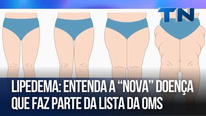 Lipedema: entenda “nova” doença que faz parte da lista da OMS | Cuide-se Bem!
