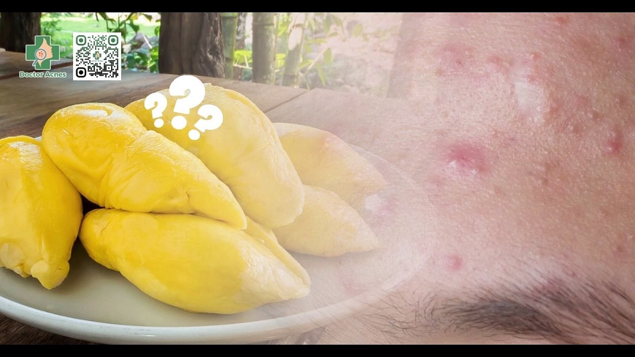Ăn sầu riêng có nổi mụn không? Cách ăn sầu riêng không nổi mụn