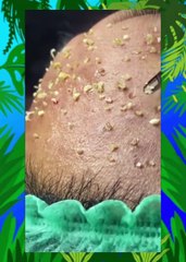 SATISFYING BLACKHEADS COMPILATION,  Clearing the Way Effective Blackhead Removal Techniques (8)