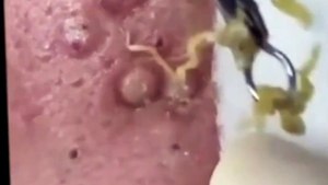 SATISFYING BLACKHEADS COMPILATION,  Clearing the Way Effective Blackhead Removal Techniques (18)