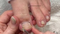 How to Clean Impacted Toenails to Prevent Ingrown Toenails 👣