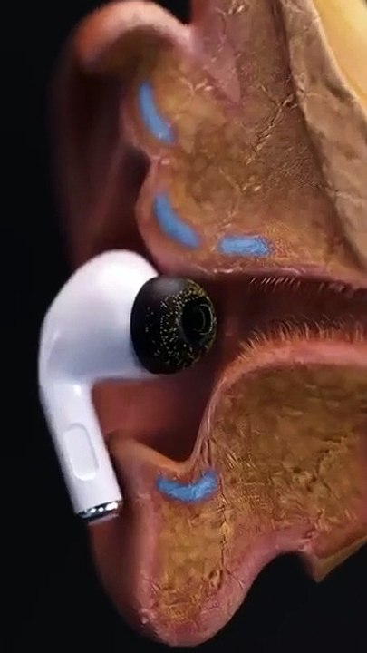 Your Earbuds Could Be Causing Ear Infections! Here’s Why 🦠👂#infection #earbuds