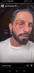 ¿Qué le pasó? Poncho De Nigris sorprende con golpe en el rostro (VIDEO)